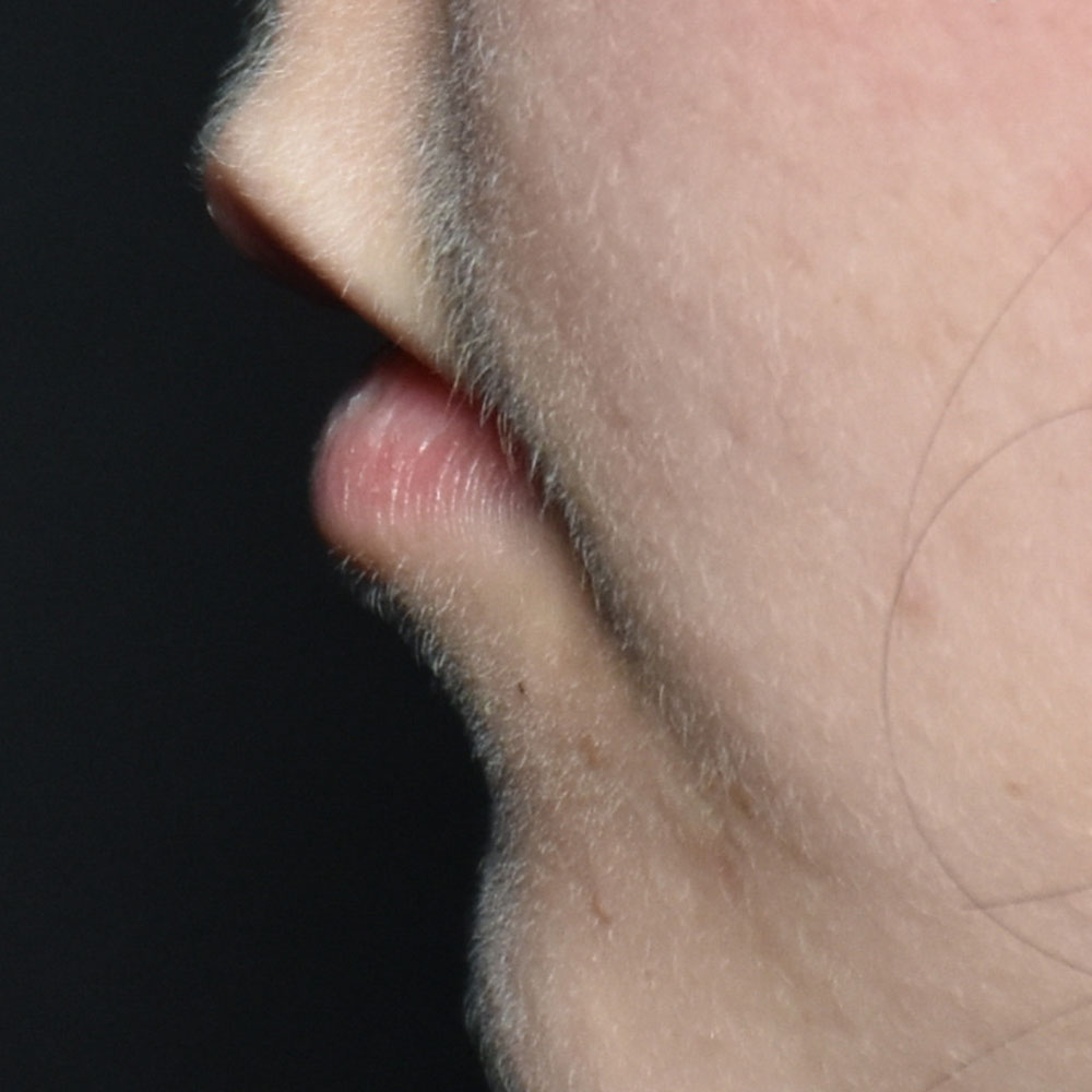 Case--2147 | Before Facial Fillers 2