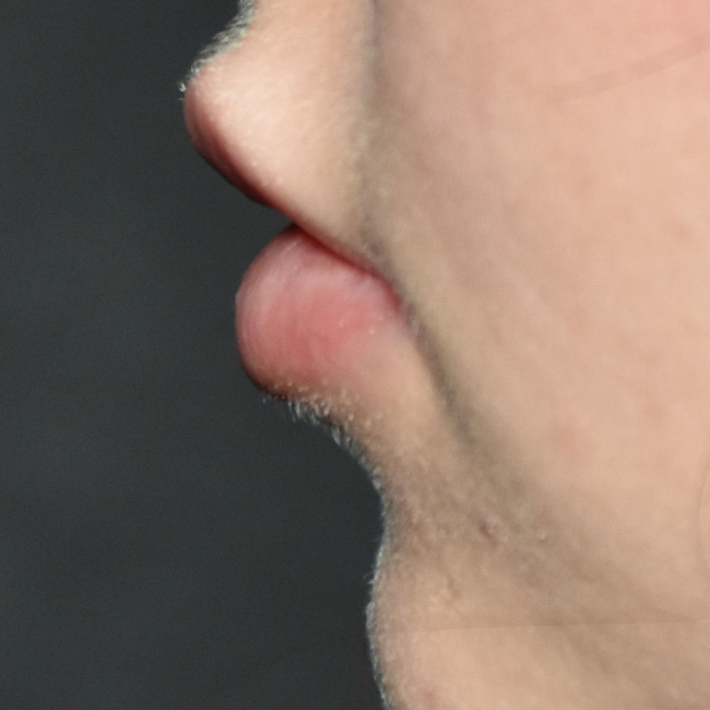 Case--2147 | After Facial Fillers 2