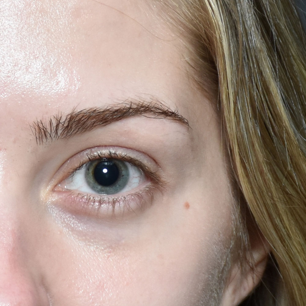 Case--2148 | Before Facial Fillers 2