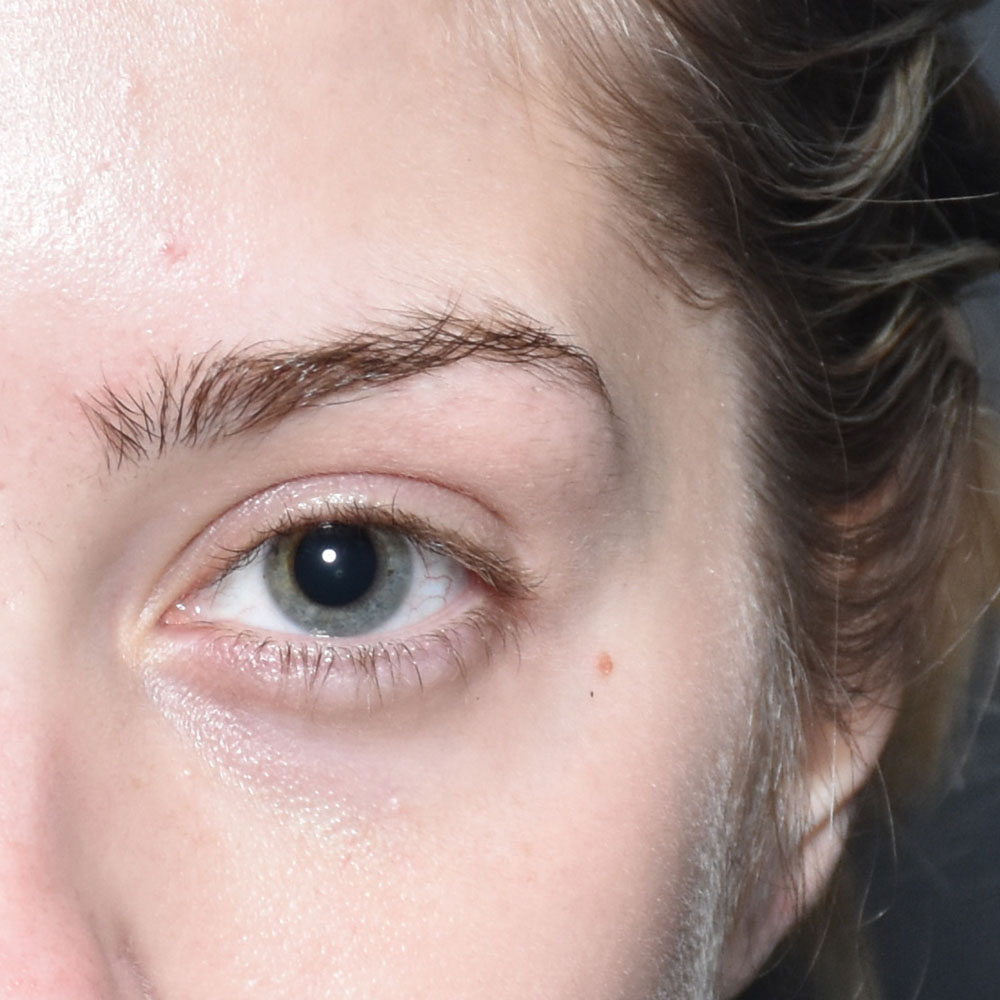 Case--2148 | After Facial Fillers 2