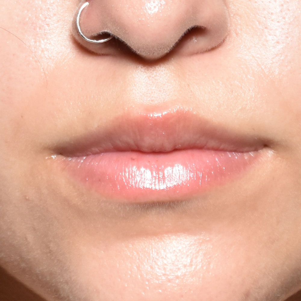 Case--2149 | Before Medspa