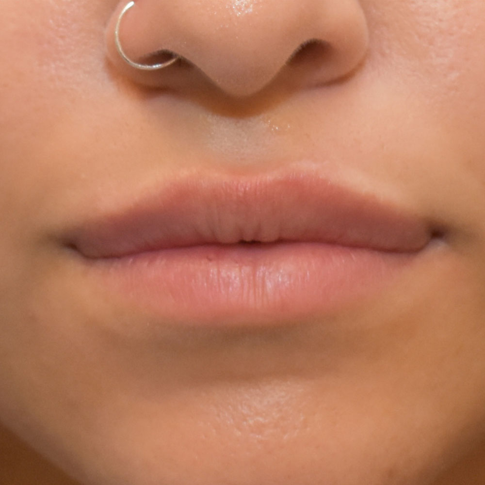 Case--2149 | After Medspa