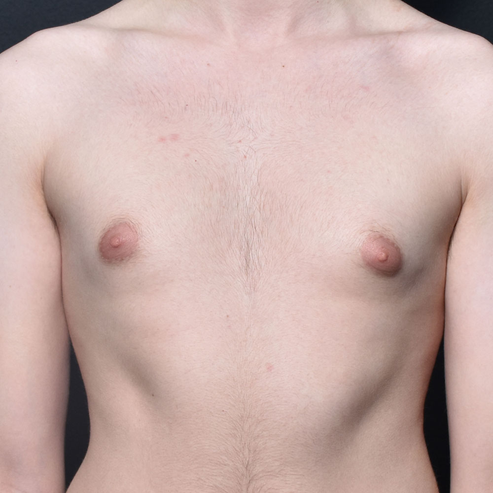 Case 10819 Front View, Before Gynecomastia in Lake Oswego & Portland, OR