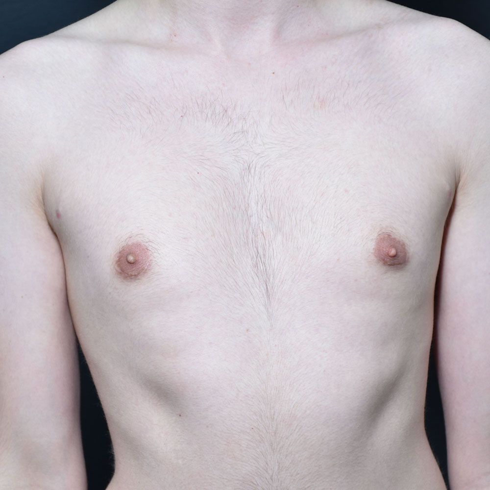 Case 10819 Front View, After Gynecomastia in Lake Oswego & Portland, OR