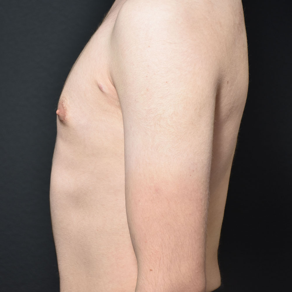 Case 10819 Side Left View, After Gynecomastia in Lake Oswego & Portland, OR