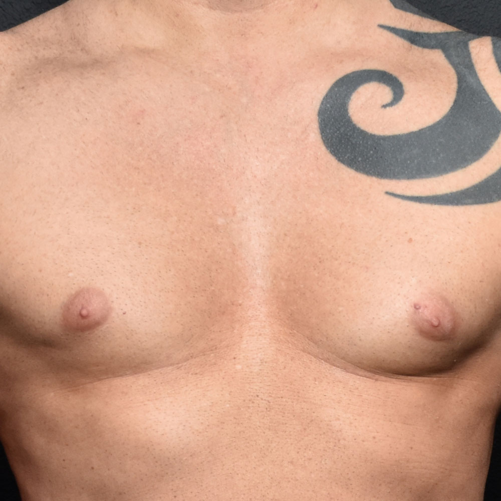 Case 9331 Front View, Before Gynecomastia in Lake Oswego & Portland, OR