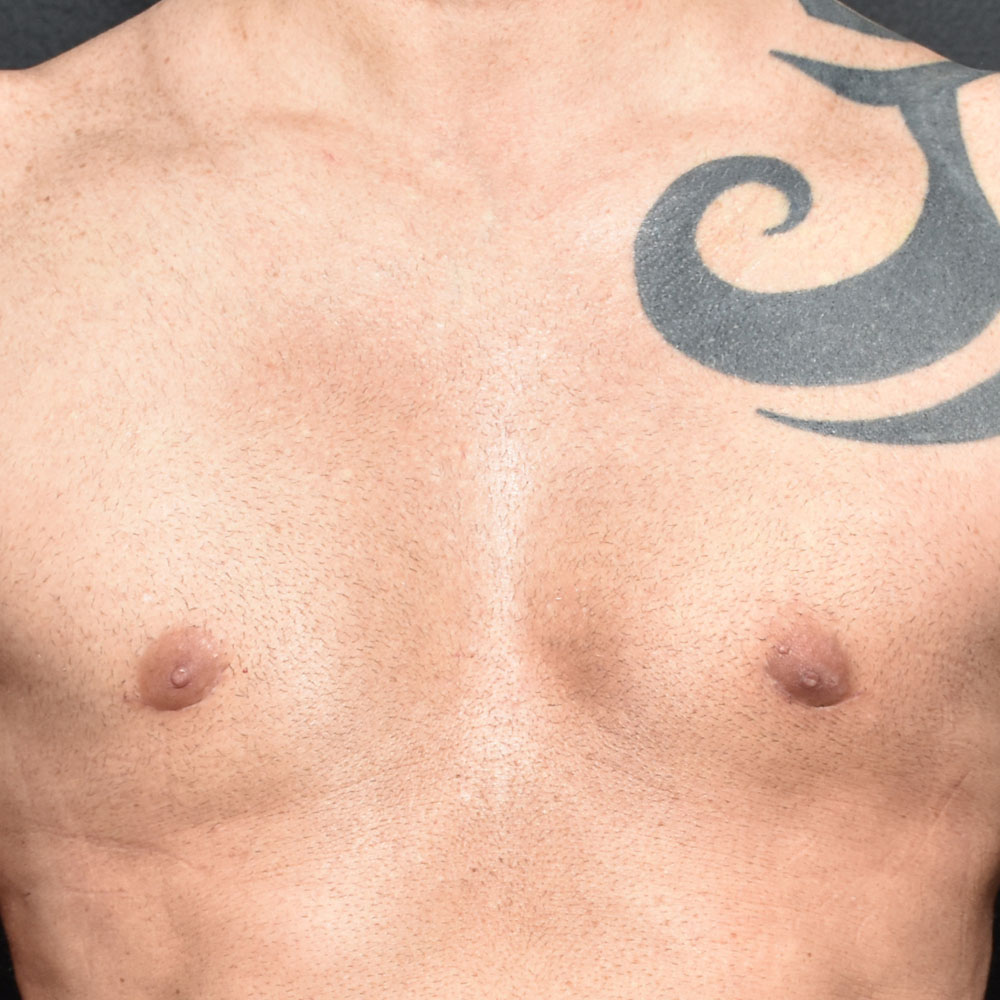 Case 9331 Front View, After Gynecomastia in Lake Oswego & Portland, OR