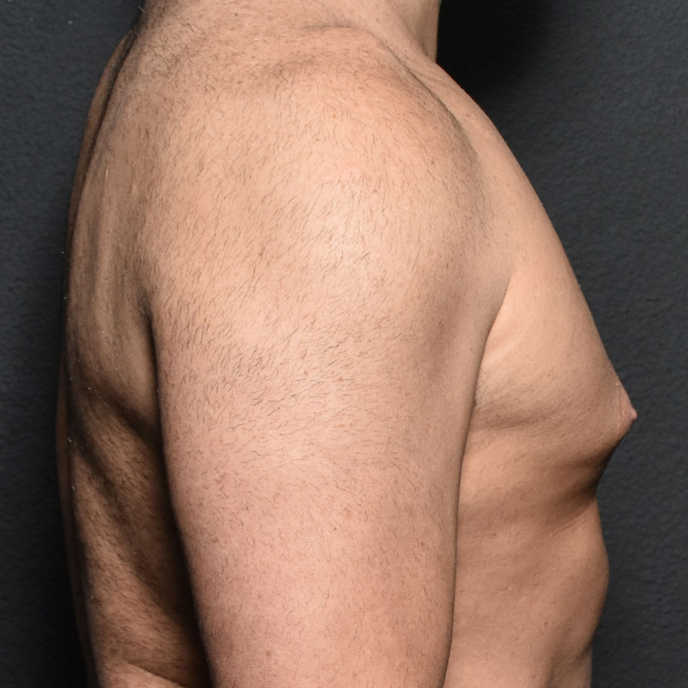 Case 9331 Side View, Before Gynecomastia in Lake Oswego & Portland, OR