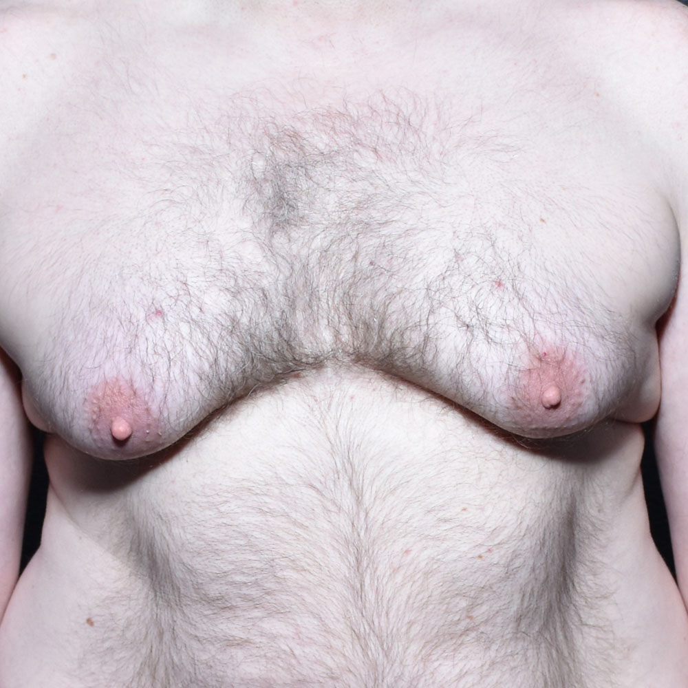 Case 9483 Front View, Before Gynecomastia in Lake Oswego & Portland, OR