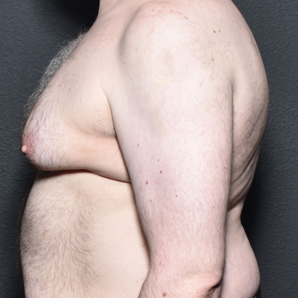 Case 9483 Side Left View, Before Gynecomastia in Lake Oswego & Portland, OR