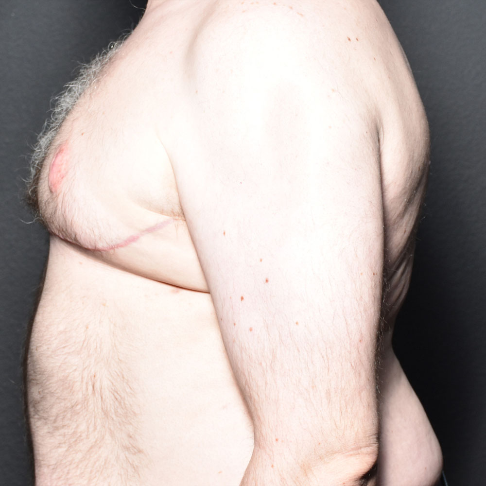 Case 9483 Side Left View, after Gynecomastia in Lake Oswego & Portland, OR