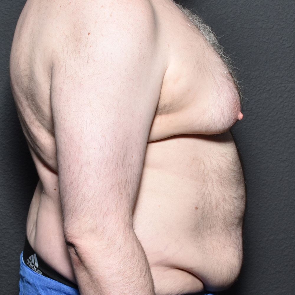 Case 9483 Side Right View, Before Gynecomastia in Lake Oswego & Portland, OR