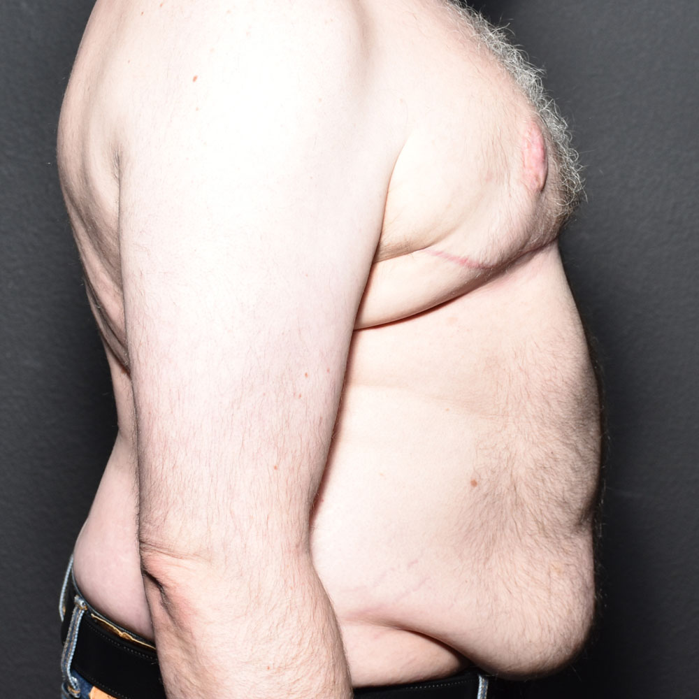 Case 9483 Side Right View, After Gynecomastia in Lake Oswego & Portland, OR