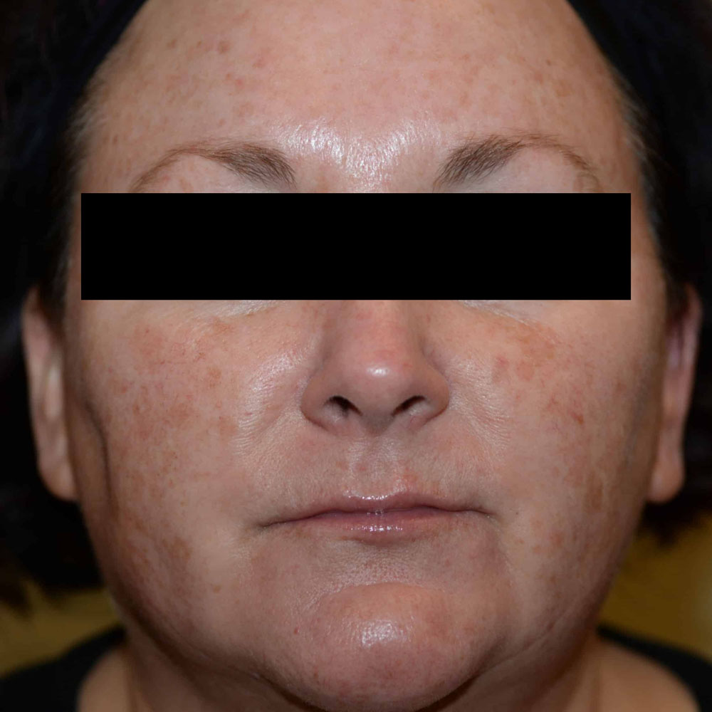 Case--2129 | Before IPL & Laser Treatments