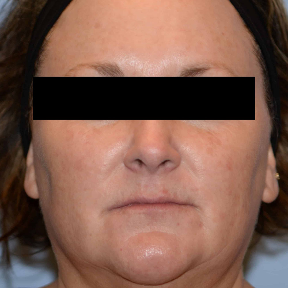 Case--2129 | After IPL & Laser Treatments