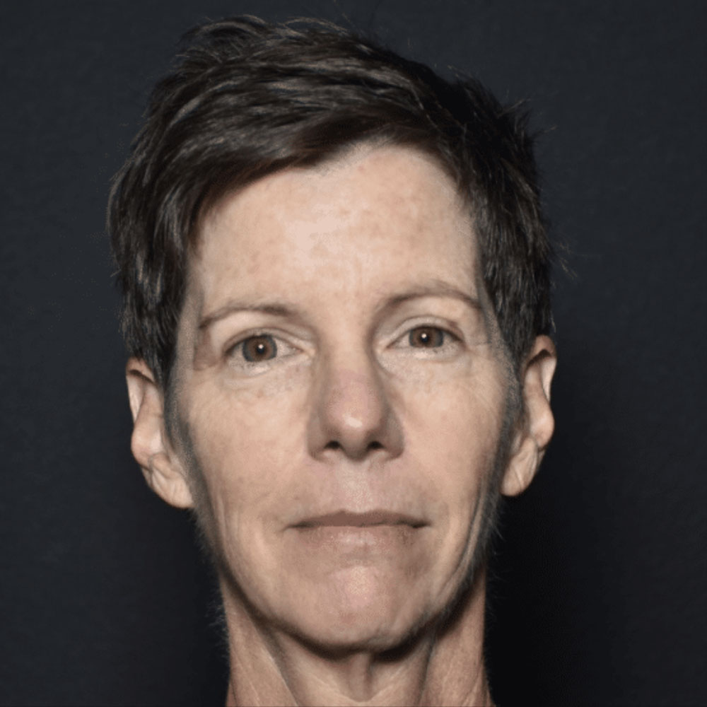 Case--2130 | After IPL & Laser Treatments