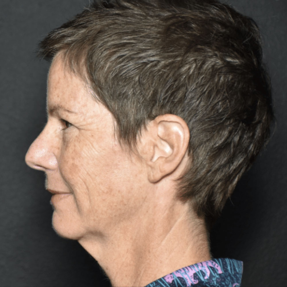 Case--2130 | Before IPL & Laser Treatments 2