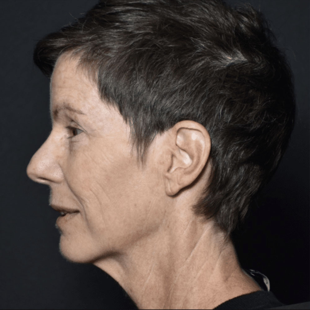 Case--2130 | After IPL & Laser Treatments 2