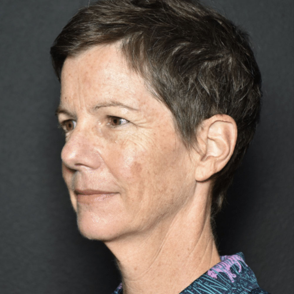 Case--2130 | Before IPL & Laser Treatments 3