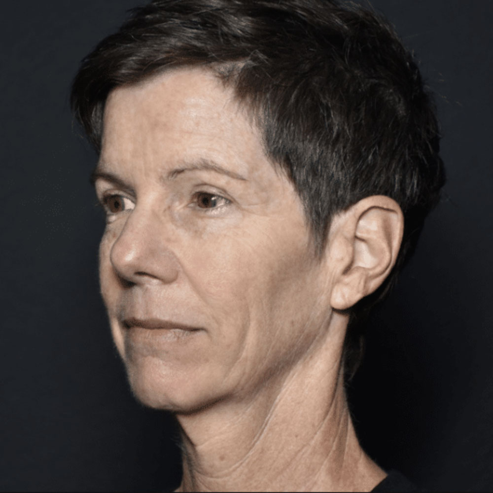 Case--2130 | After IPL & Laser Treatments 3