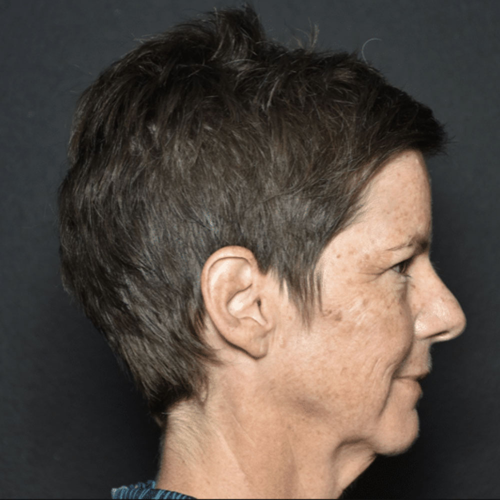 Case--2130 | Before IPL & Laser Treatments 4