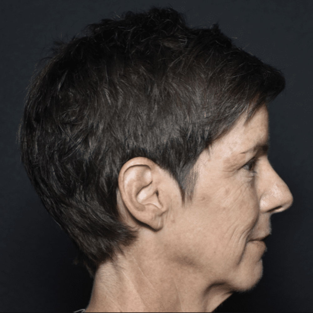 Case--2130 | After IPL & Laser Treatments 4