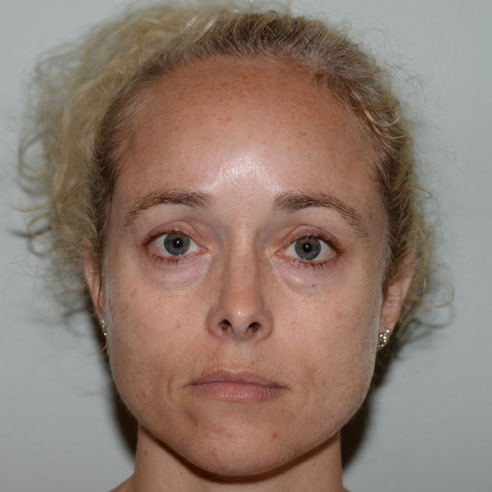 Case--2131 | Before IPL & Laser Treatments