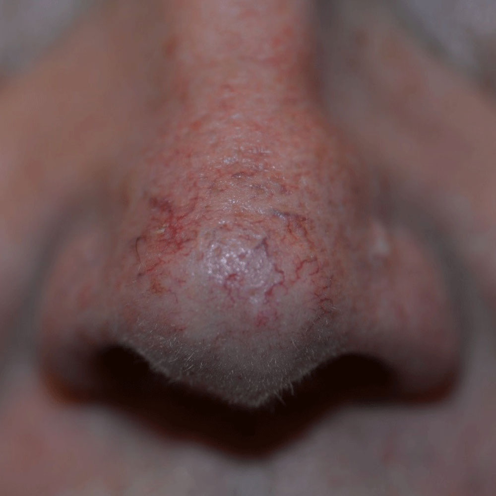 Case--2132 | Before IPL & Laser Treatments