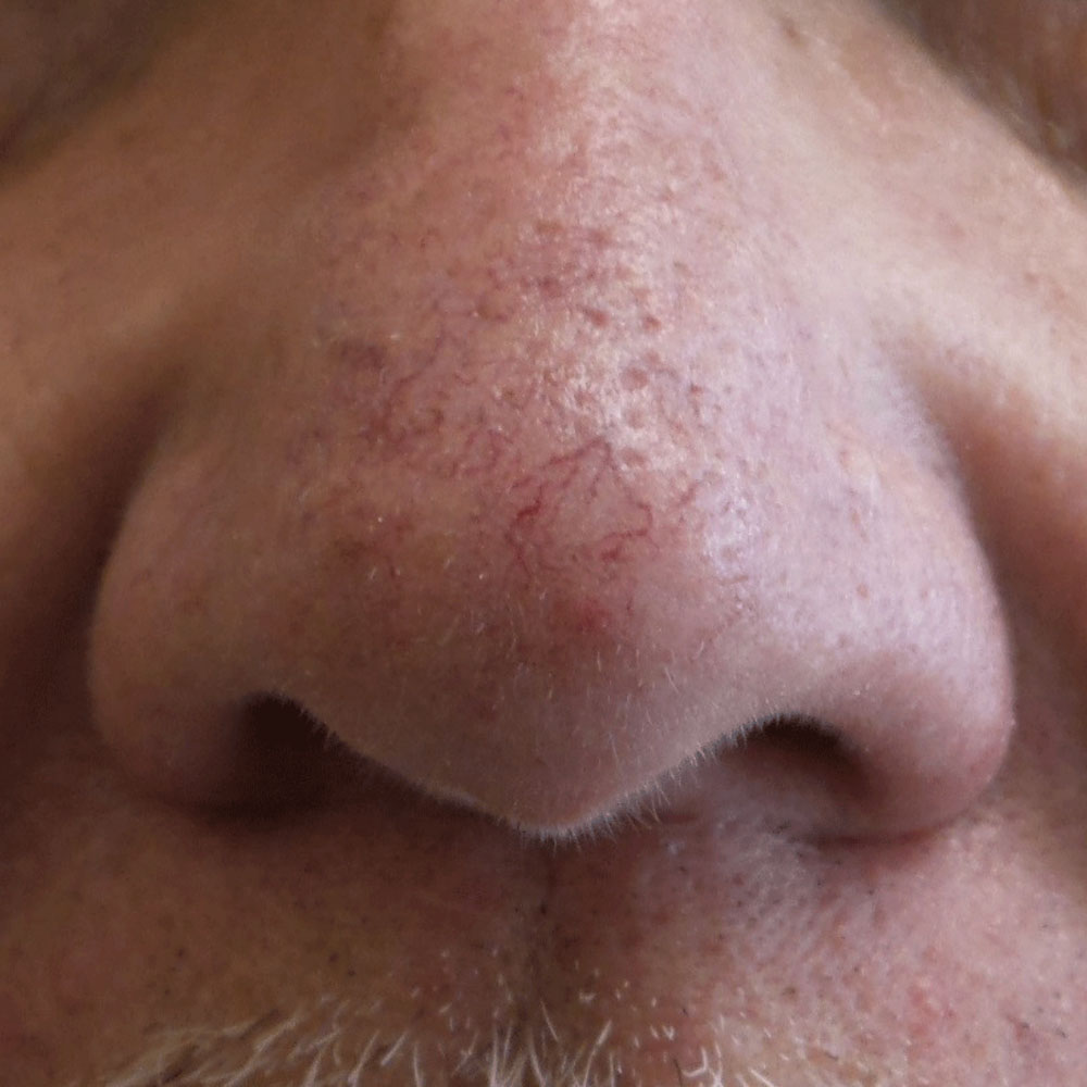 Case--2132 | After IPL & Laser Treatments