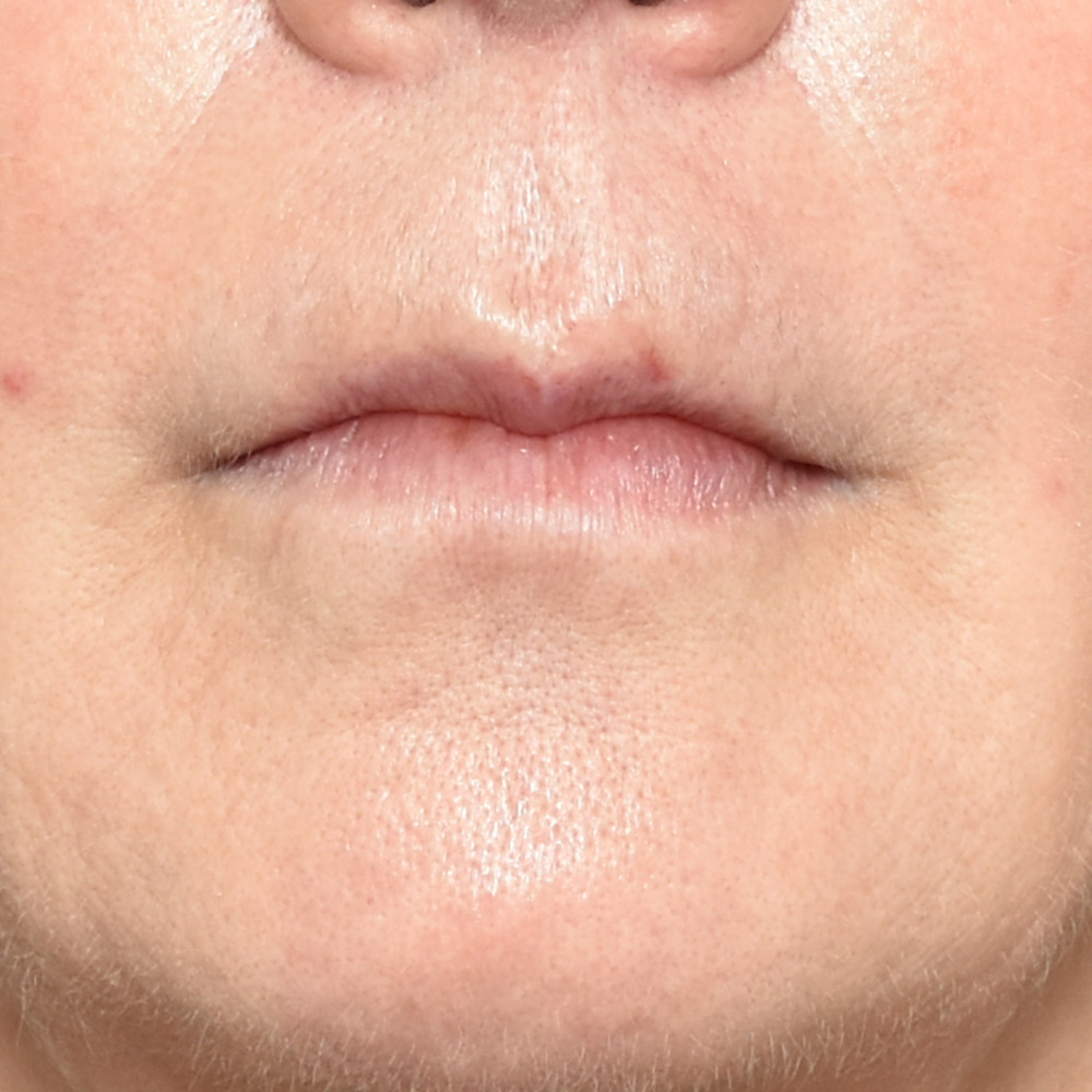 10947 Before Lip Lift - Lake Oswego and Portland, Oregon