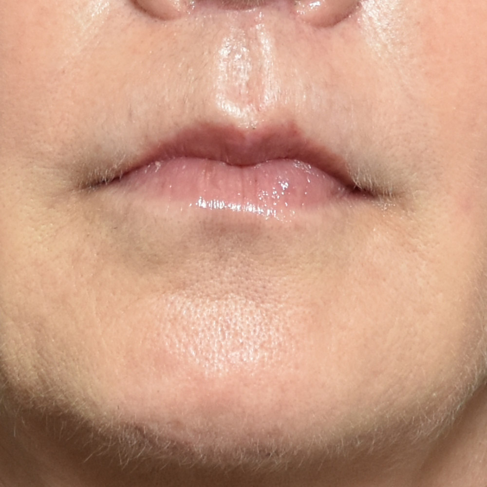 10947 After Lip Lift - Lake Oswego and Portland, Oregon