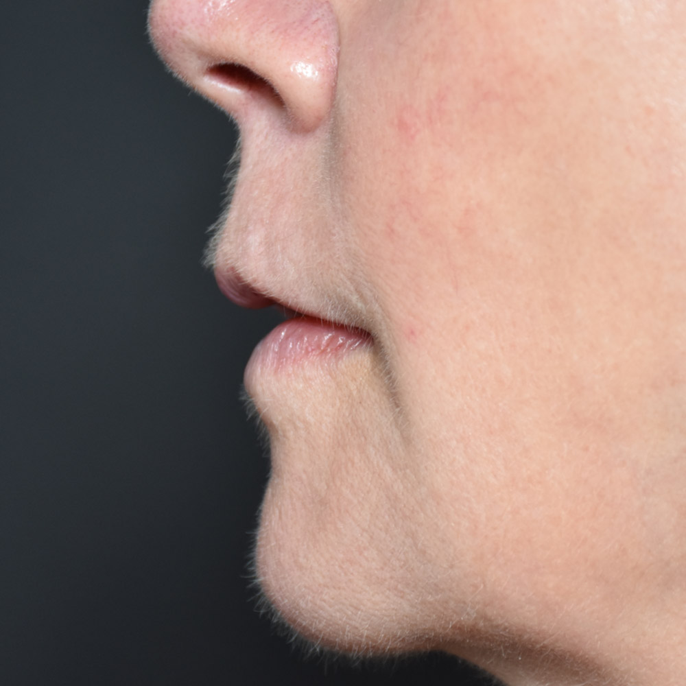 10947 Before Lip Lift - Lake Oswego and Portland, Oregon