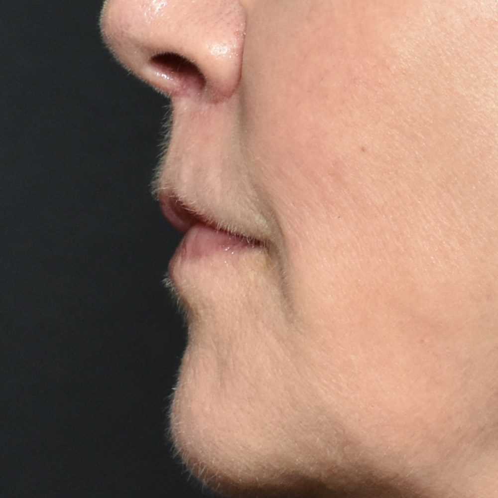 10947 After Lip Lift - Lake Oswego and Portland, Oregon