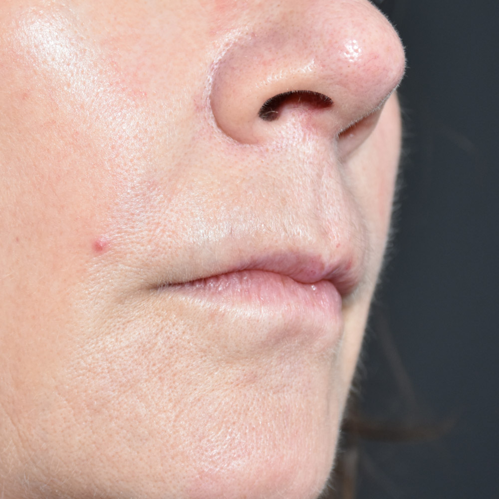 10947 Before Lip Lift - Lake Oswego and Portland, Oregon