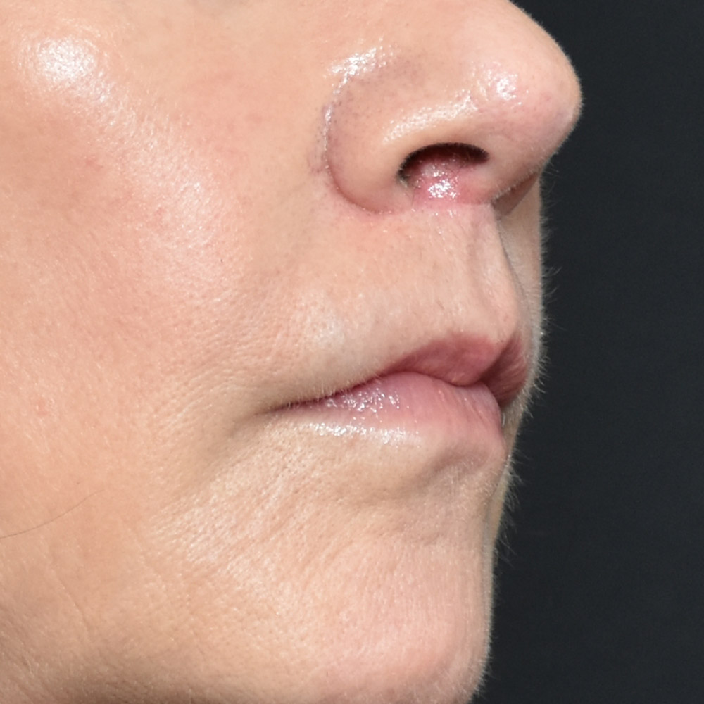 10947 After Lip Lift - Lake Oswego and Portland, Oregon