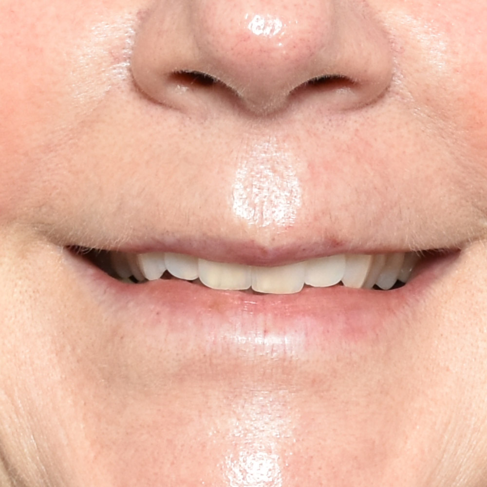 10947 Before Lip Lift - Lake Oswego and Portland, Oregon