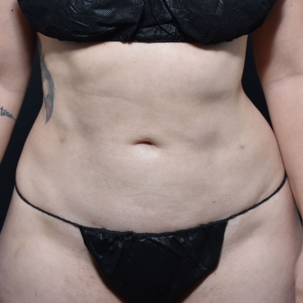 10914 After Liposuction Front View - Lake Oswego & Portland, OR