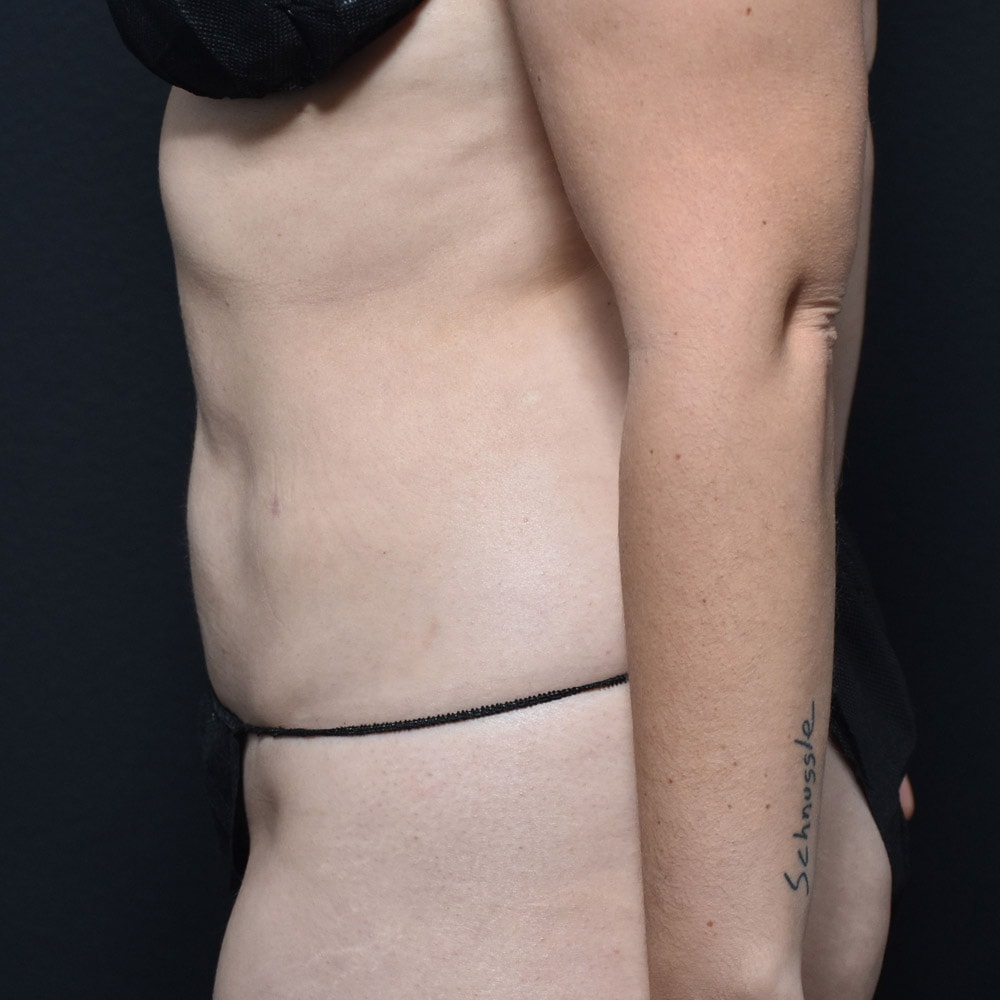 10914 After Liposuction Profile View - Lake Oswego & Portland, OR