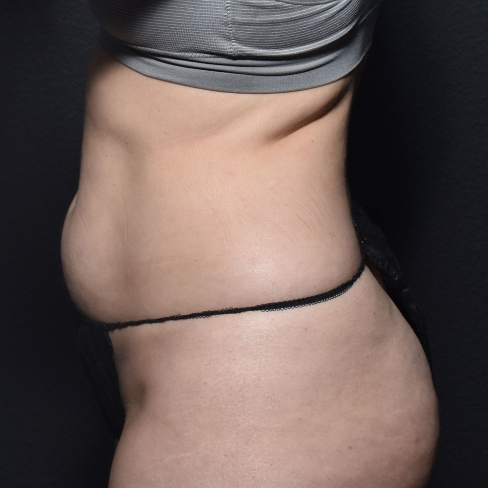 10914 Before Liposuction Profile View - Lake Oswego & Portland, OR