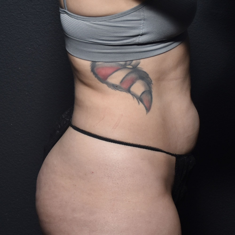 10914 Before Liposuction Profile View - Lake Oswego & Portland, OR