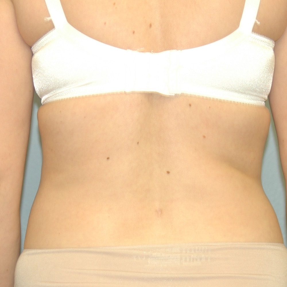 19719 After Liposuction Back View - Lake Oswego & Portland, OR