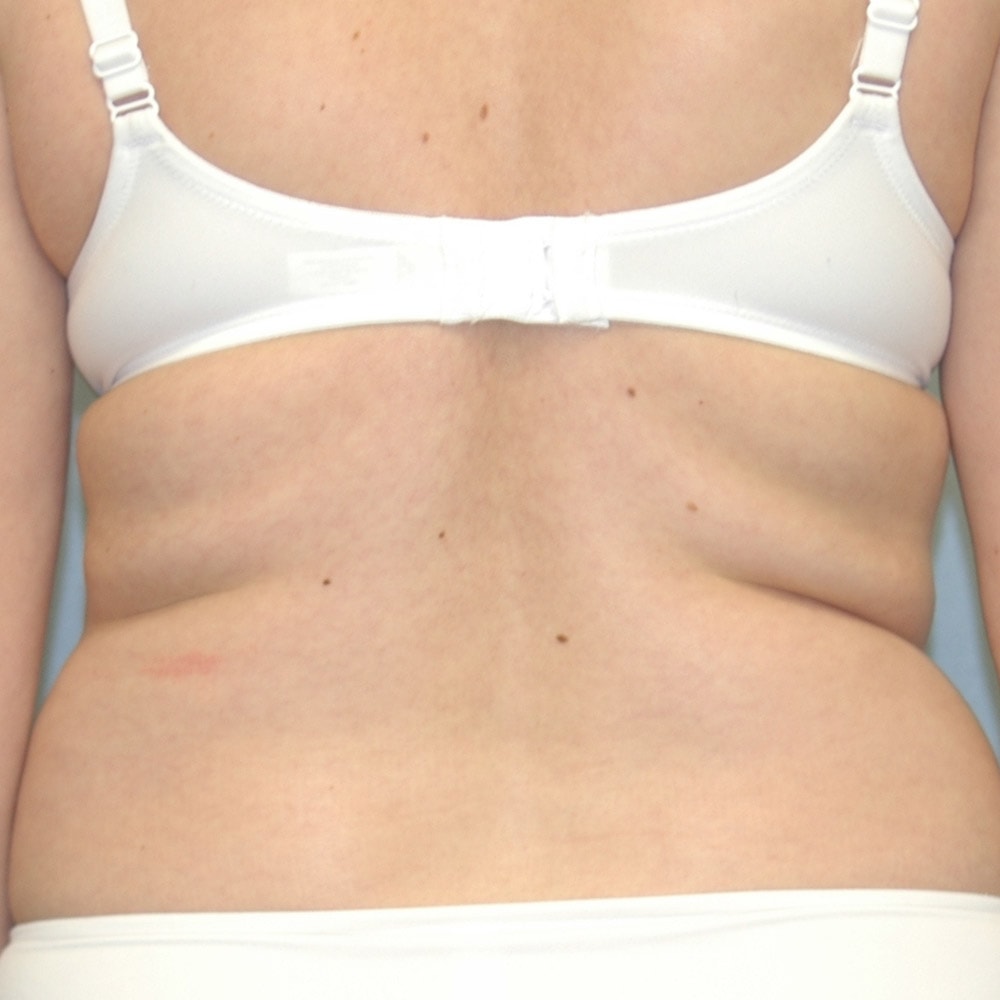 19719 Liposuction Back View Before - Lake Oswego & Portland, OR