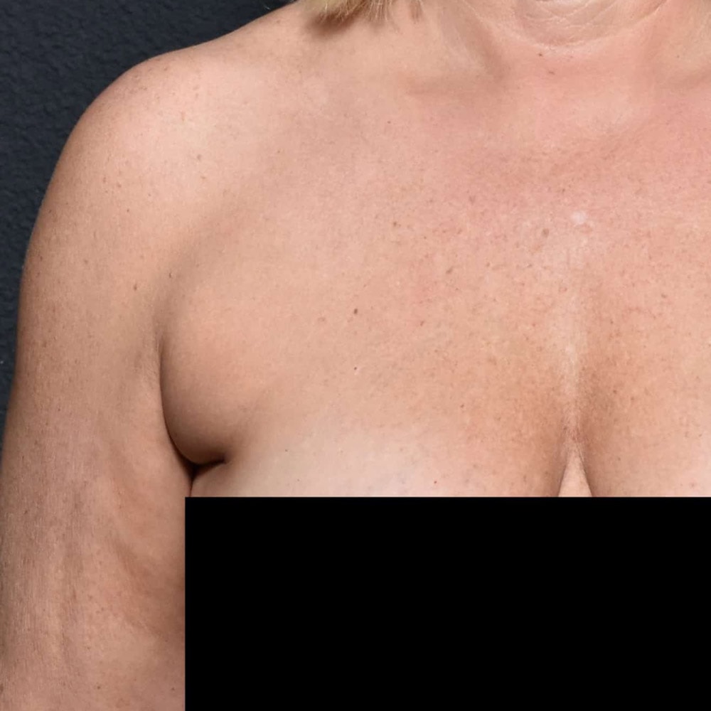 60205 Before Liposuction Front View - Lake Oswego & Portland, OR