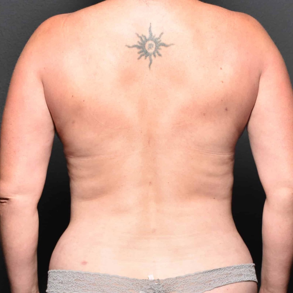 60212 After Liposuction Back View - Lake Oswego & Portland, OR