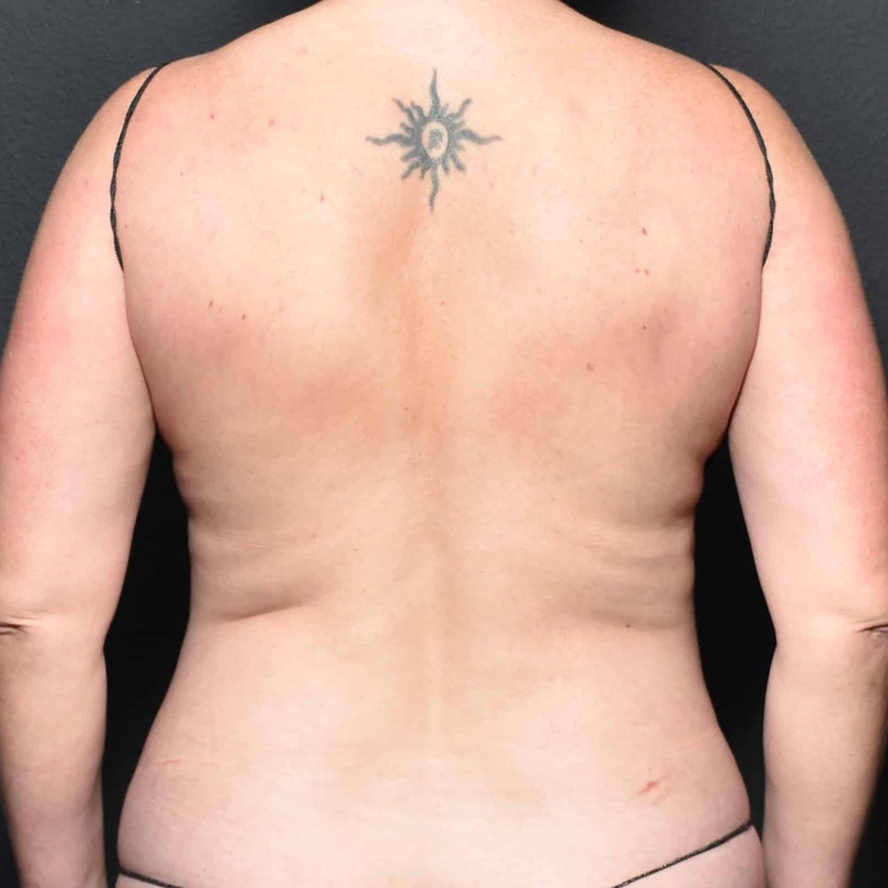 60212 Before Liposuction Back View - Lake Oswego & Portland, OR