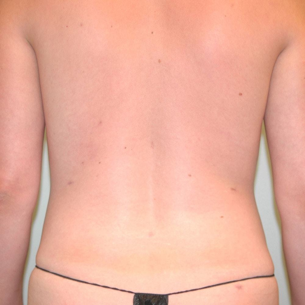 61974 After Liposuction Back View - Lake Oswego & Portland, OR
