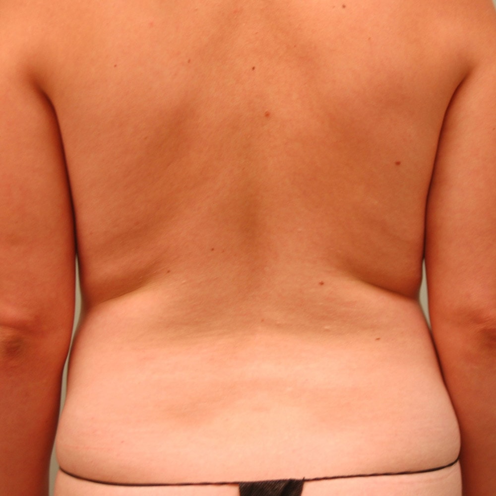 61974 Before Liposuction Back View - Lake Oswego & Portland, OR