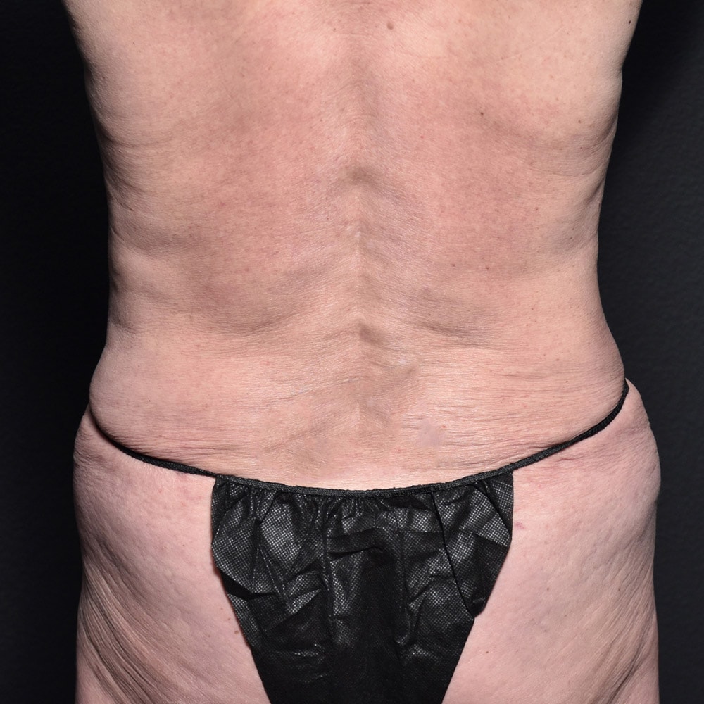 9058 After Liposuction Back View - Lake Oswego & Portland, OR