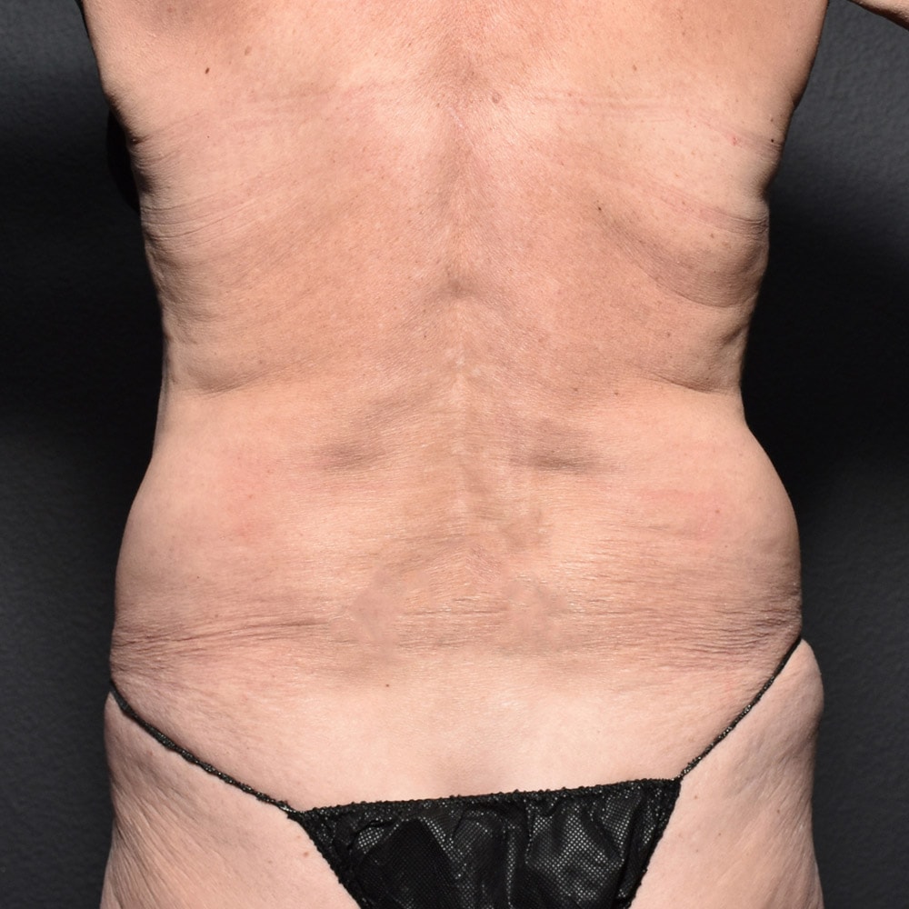 9058 Before Liposuction Back View - Lake Oswego & Portland, OR