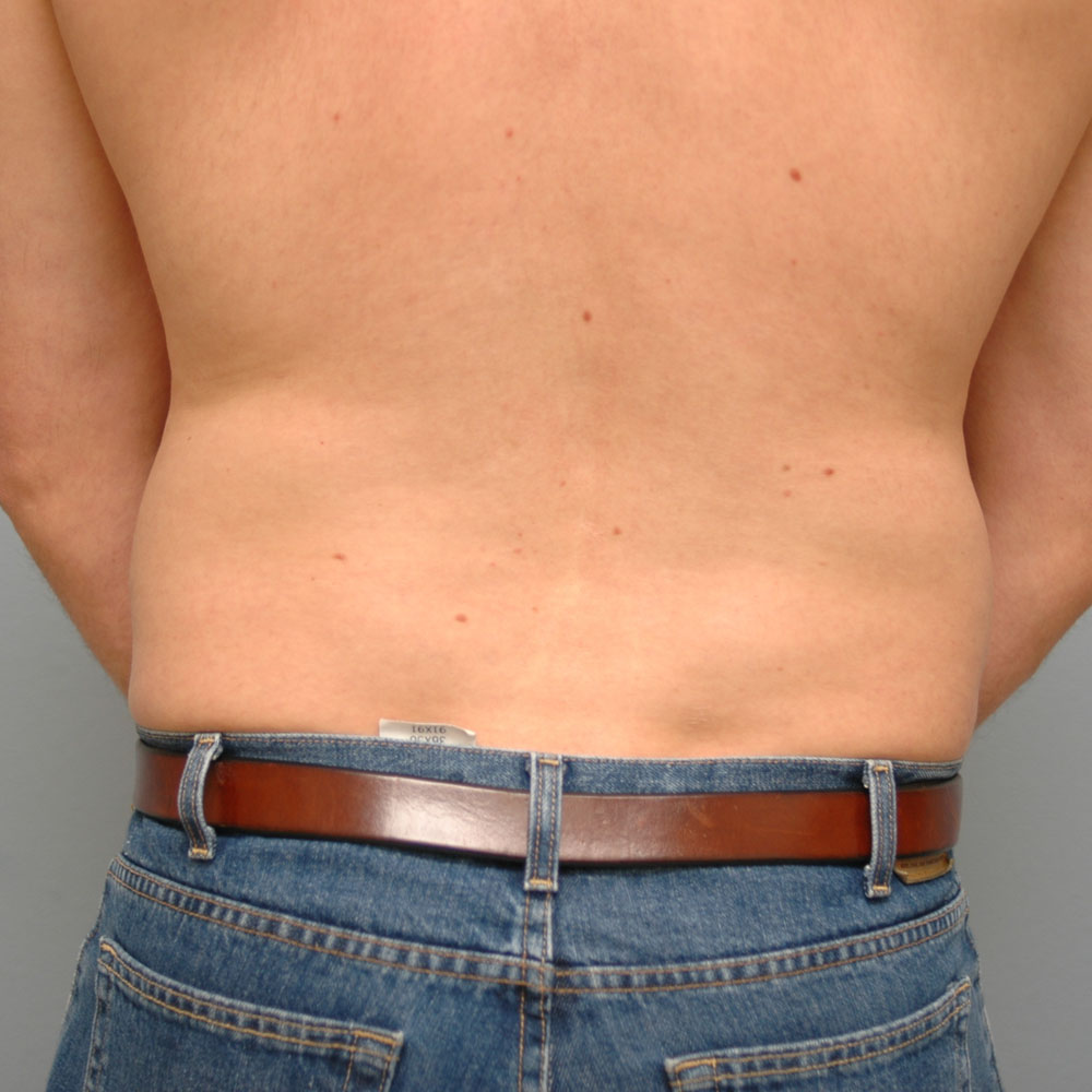 Case 1010 Back View, Before Male Liposuction in Lake Oswego & Portland, OR